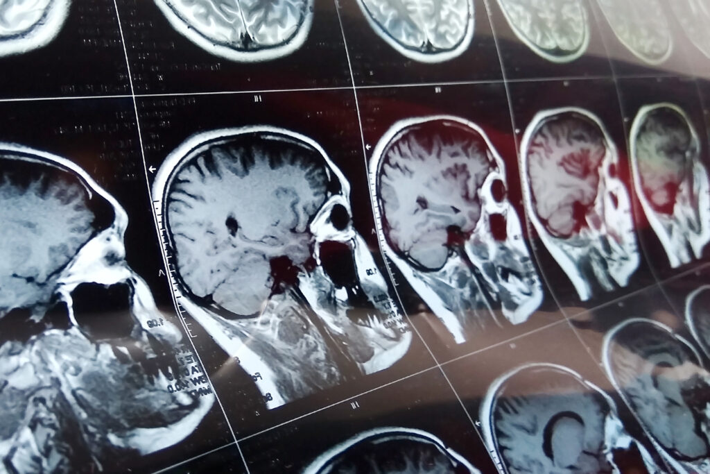 head injuries. brain scans