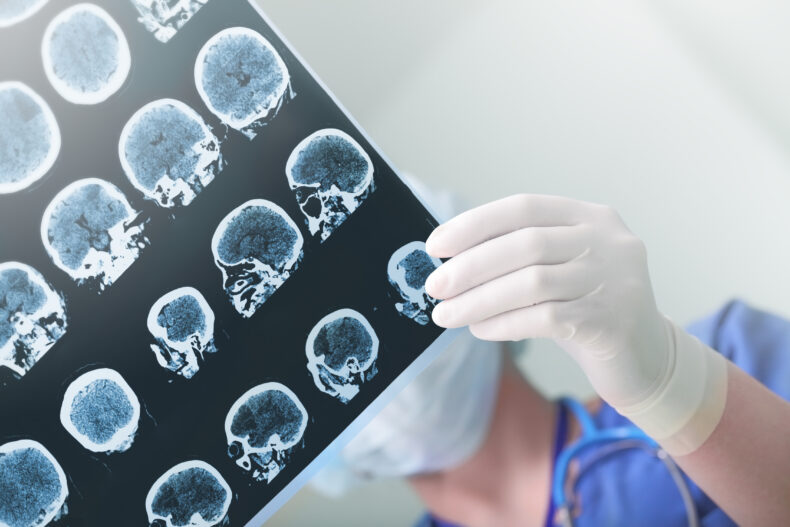 Mild traumatic brain injury vs severe injury